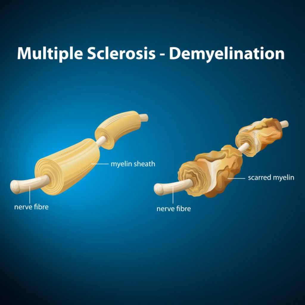 What is multiple sclerosis